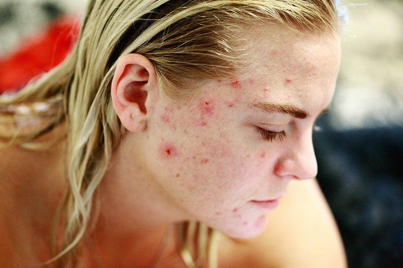 The truth about acne